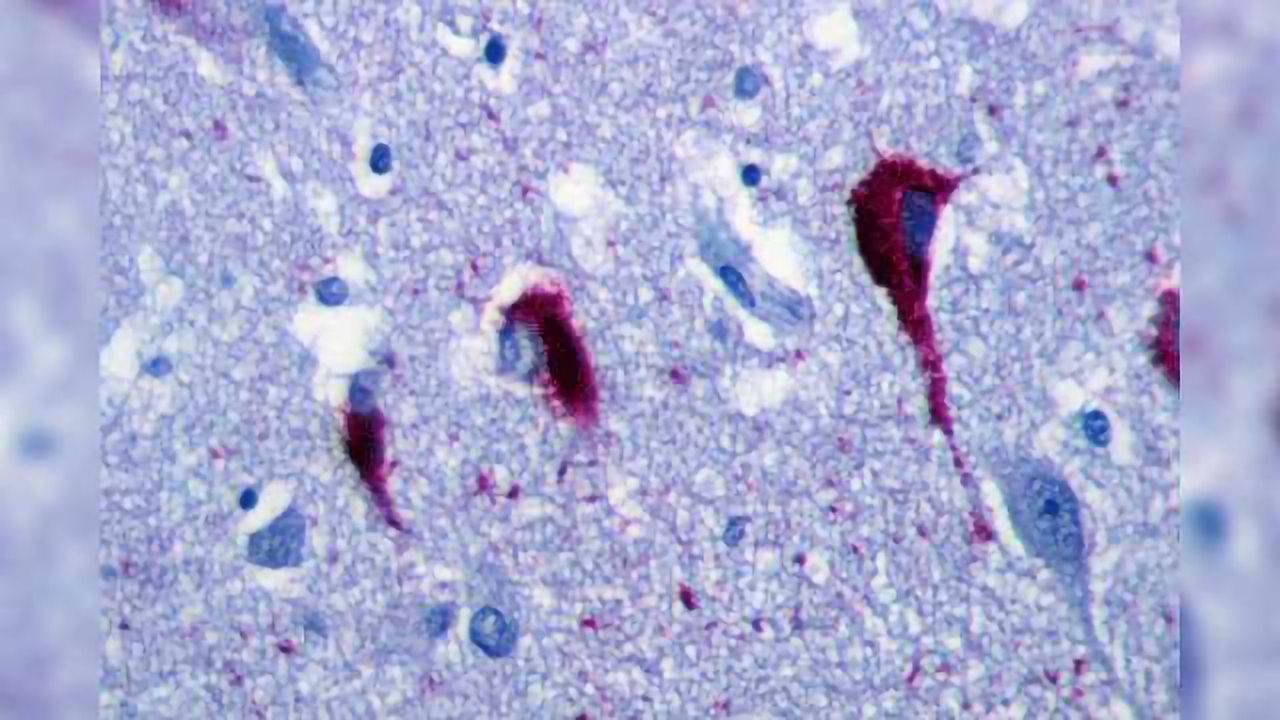 Pathological Tau Accumulates More in Excitatory, than Inhibitory, Neurons