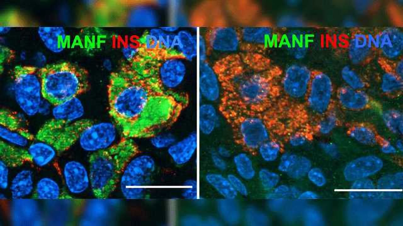 CRISPR-edited Stem Cells Reveal New Contributors to Diabetes Development