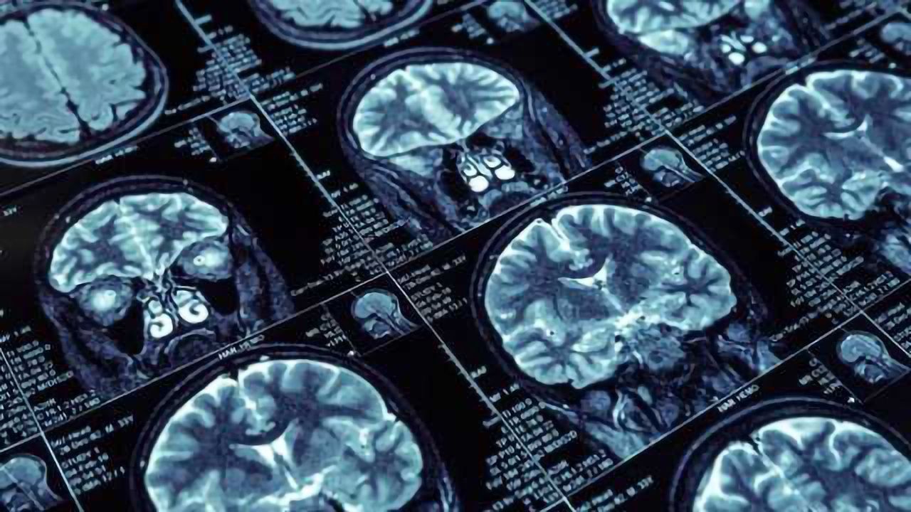 Why Men Are More Likely to Die of Brain Cancer Than Women
