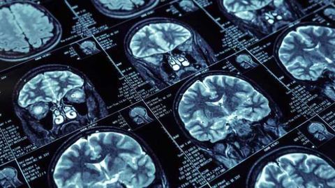Why Men Are More Likely to Die of Brain Cancer Than Women