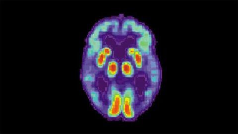 Deep-learning Algorithm Detects Alzheimer's 6 Years Before Clinical Diagnosis