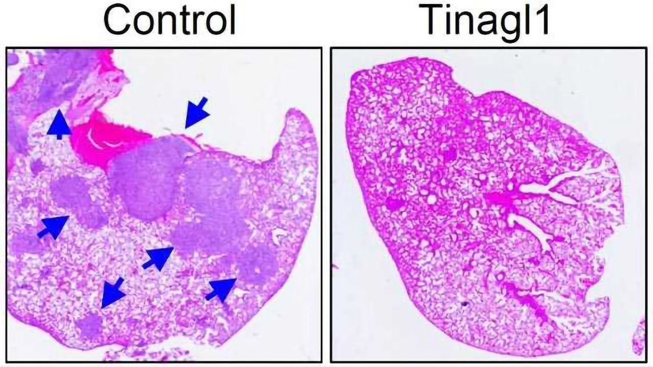Therapy Reduces Spread of Triple-negative Breast Cancer in Study