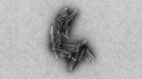 New Test Detects Protein Associated With Alzheimer's and CTE
