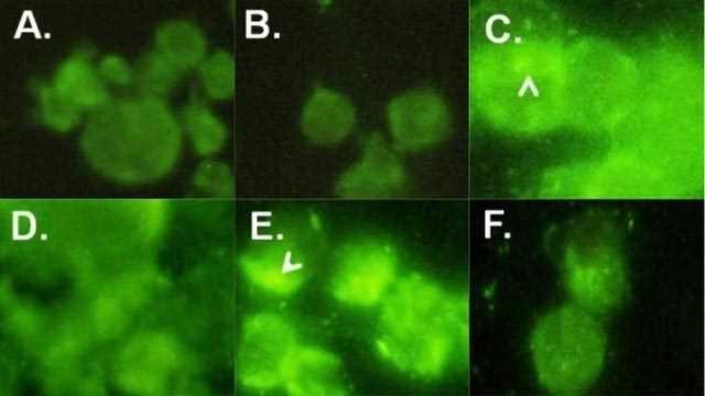 New Biomarker for Colorectal Cancers Discovered content piece image 