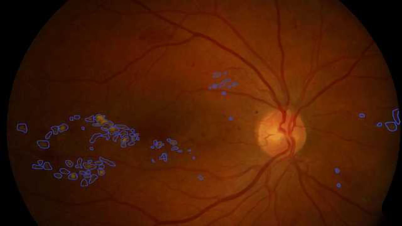 AI Supports Diagnosis of Diabetic Retinopathy