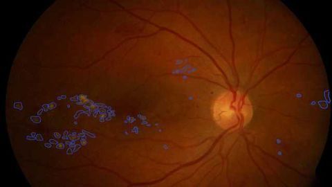 AI Supports Diagnosis of Diabetic Retinopathy