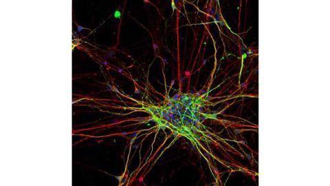 Neurons Develop Differently in Autism