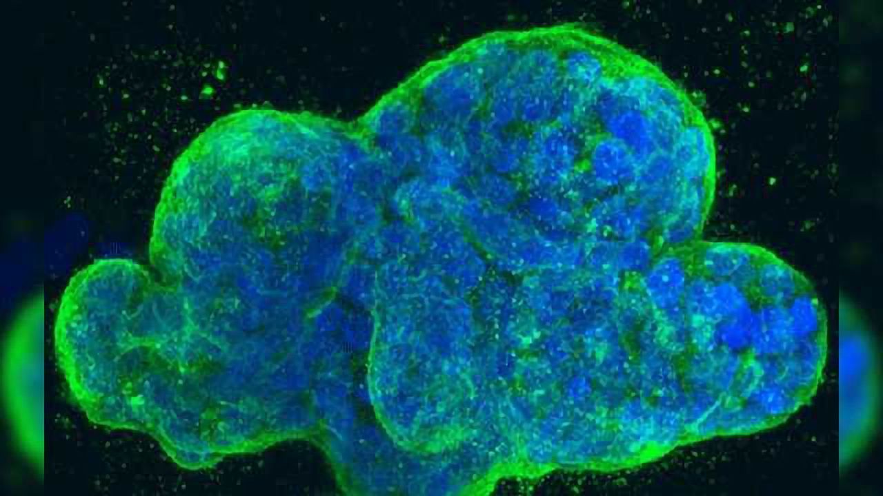 Errant Editing Enzyme Promotes Tumor Suppressor Loss and Leukemia Propagation