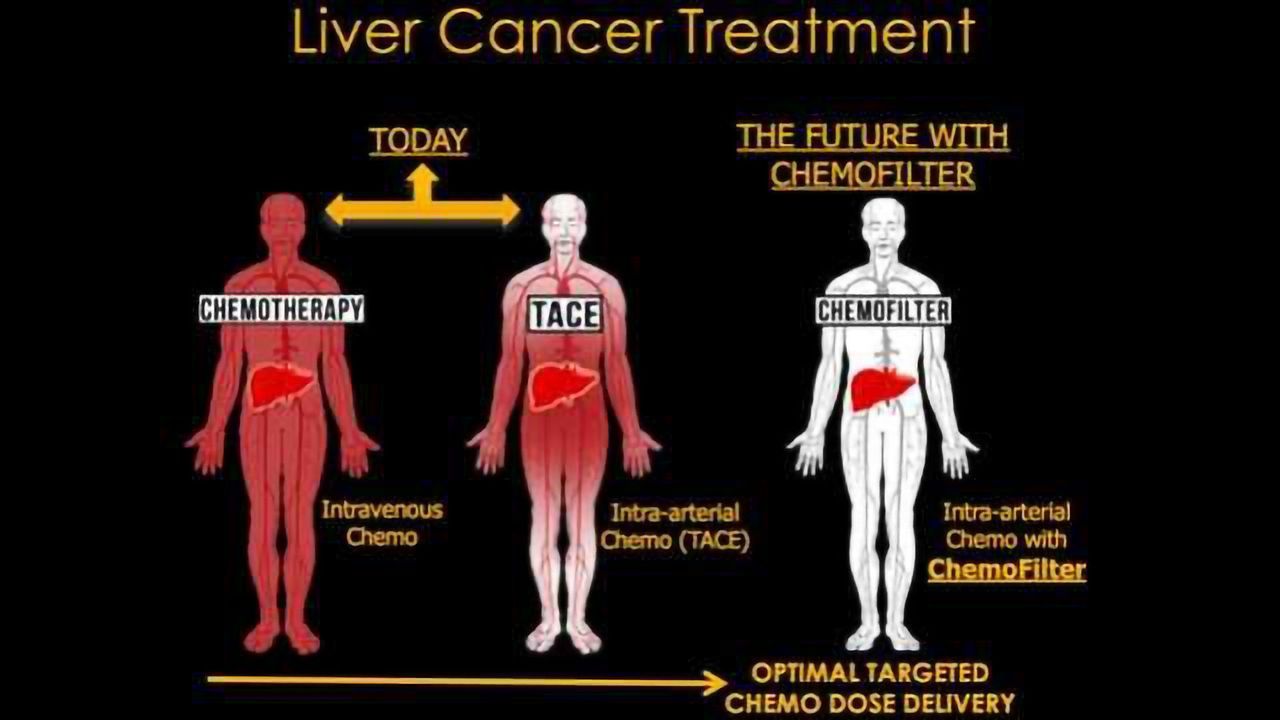 Drug Sponge Could Minimize Cancer Treatment Side Effects