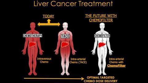 Drug Sponge Could Minimize Cancer Treatment Side Effects