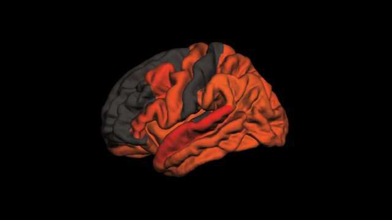 Poor Sleep Associated With Higher Levels of Alzheimer's Protein