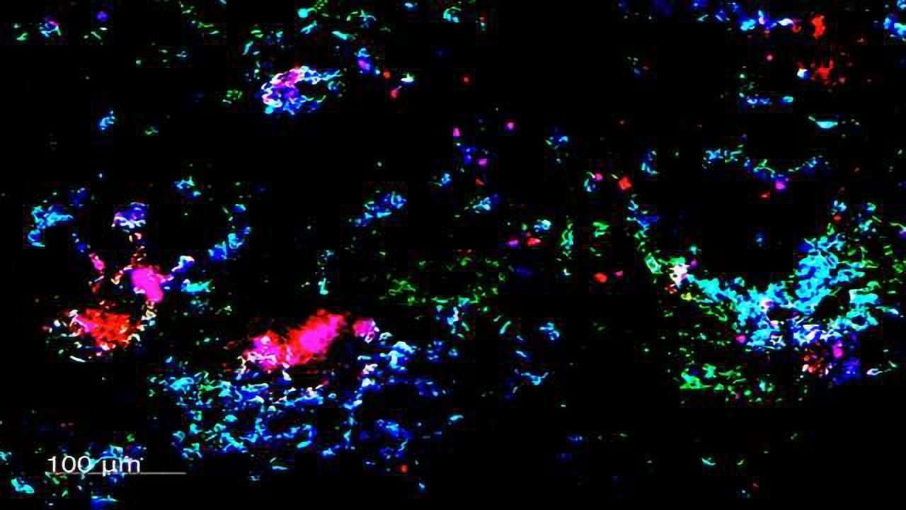 Novel Tumour Suppressor Protein Could Impact Breast Cancer Therapy