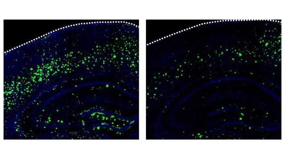 Mouse Study Suggests Stroke Drug May Prevent Alzheimer’s Disease content piece image