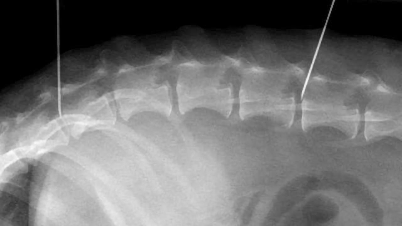 Embedded Chondroitinase ABC Shows Promise for Spinal Injury Treatment