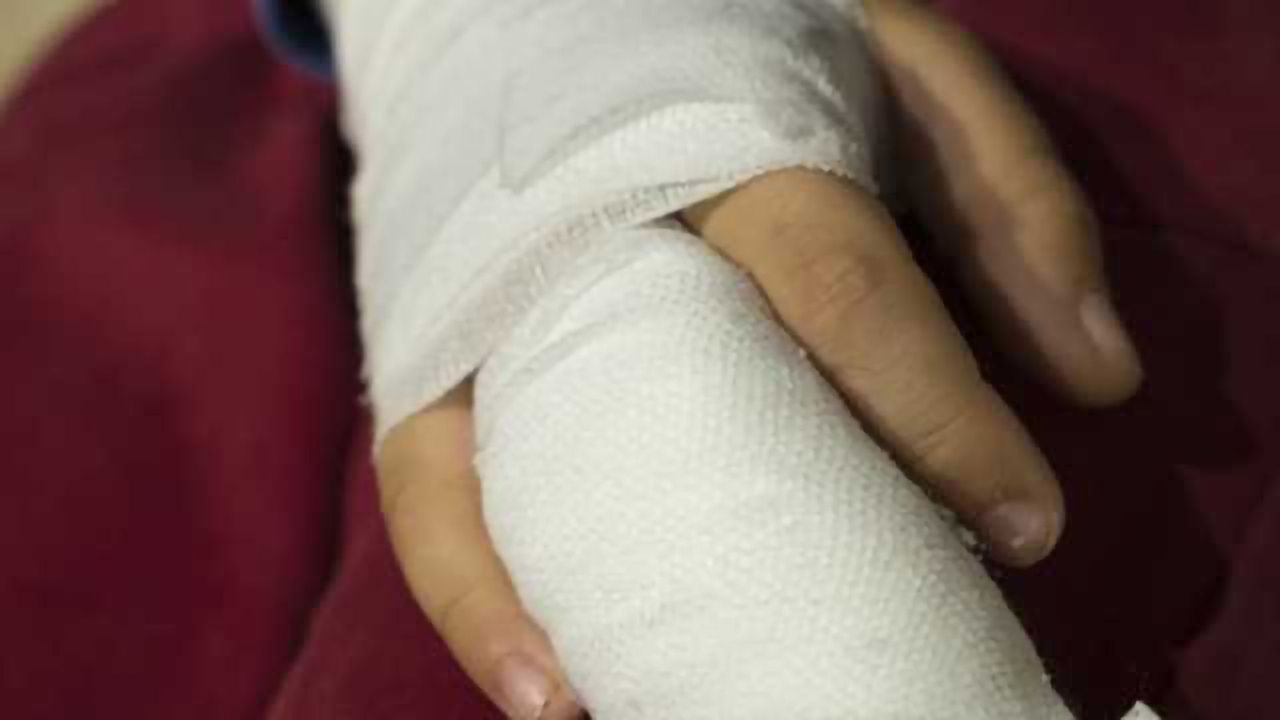 Burn Severity Could be Determined from Blister Fluid