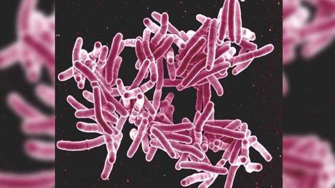 Tuberculosis Tests are Inadequate, Better Options Identified