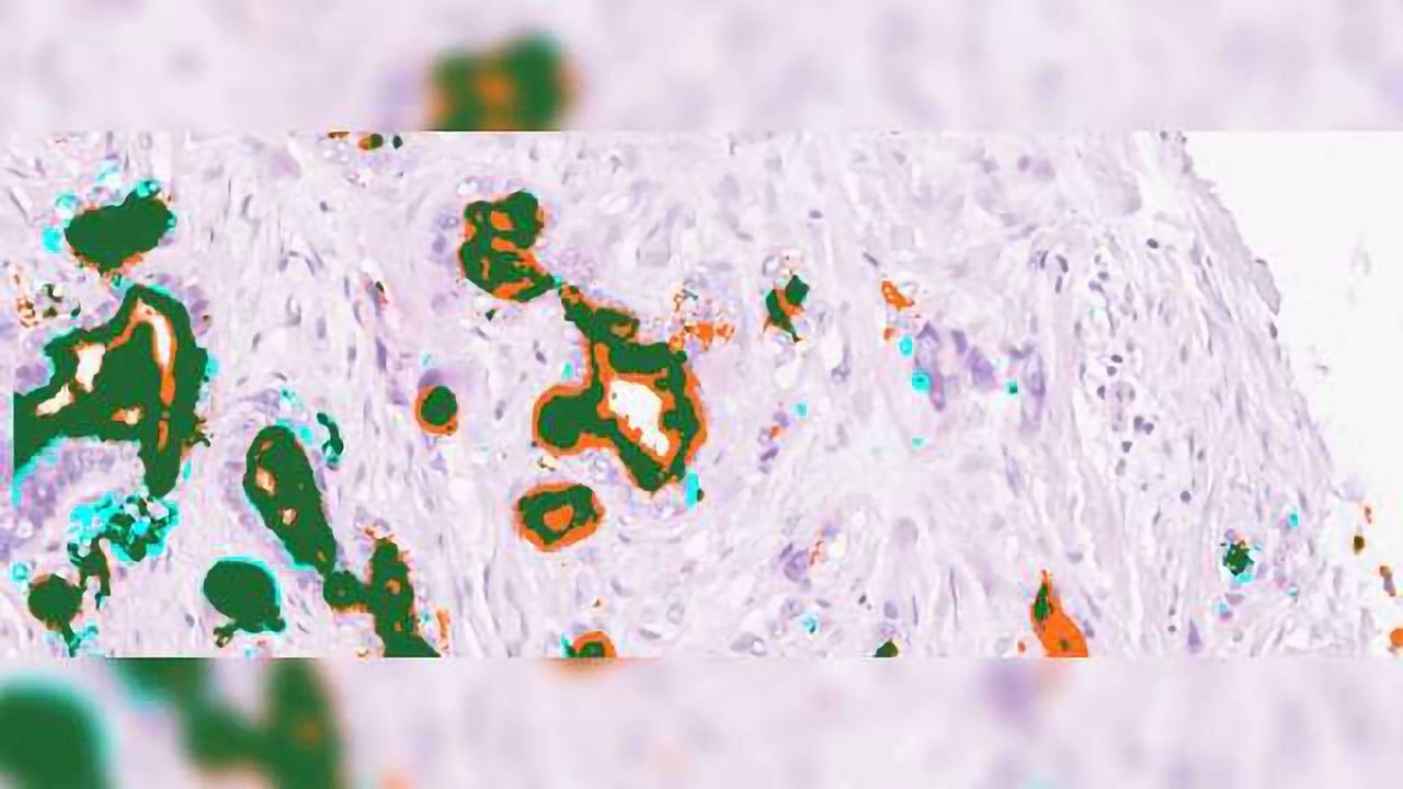 New Biomarkers Detect 70% of Pancreatic Cancer, a Vast Improvement