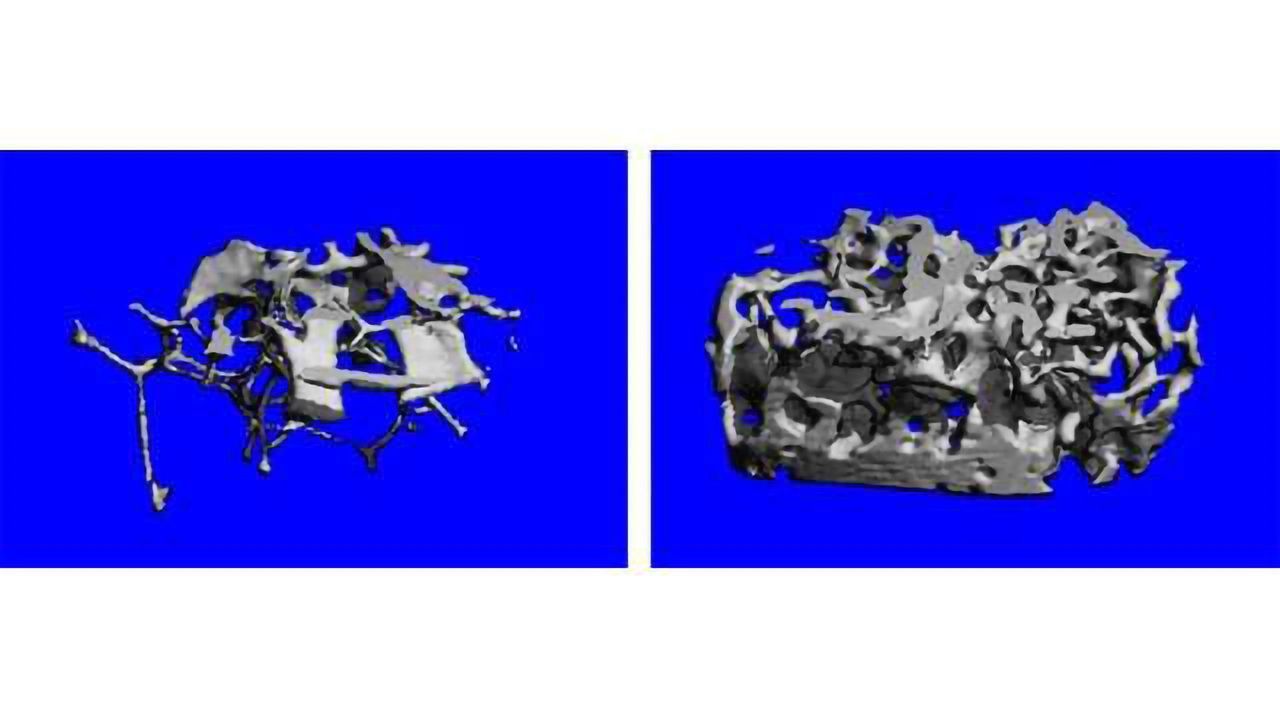 Interference with Estrogen Signaling Sends Bone Formation into Overdrive