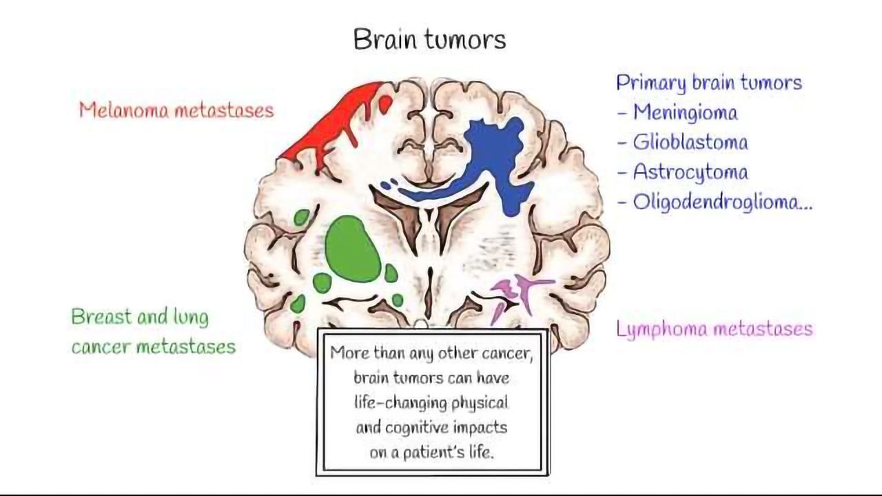 How Does Solid Stress from Brain Tumors Damage Healthy Tissue?