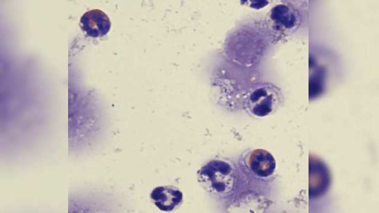 Secret to Sepsis May Lie in Rare Cell