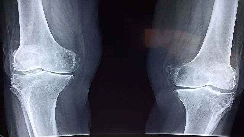 Genetics Reveal New Treatment Options for Osteoarthritis content piece image