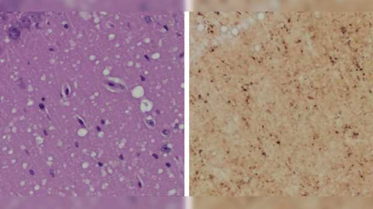 Pre-symptomatic Skin Test for Prion Disease May Replace Brain Biopsy
