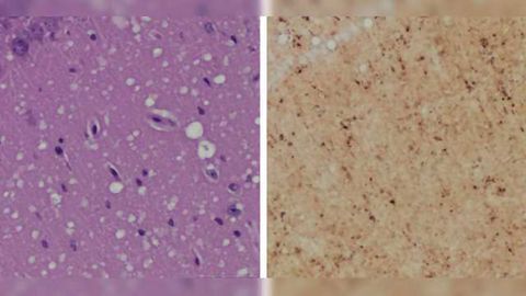 Pre-symptomatic Skin Test for Prion Disease May Replace Brain Biopsy