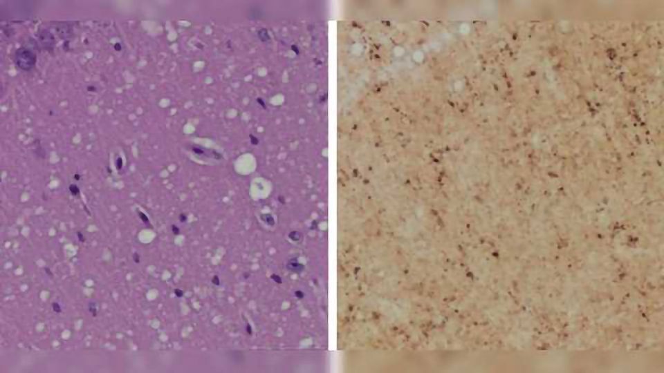 Pre-symptomatic Skin Test for Prion Disease May Replace Brain Biopsy content piece image