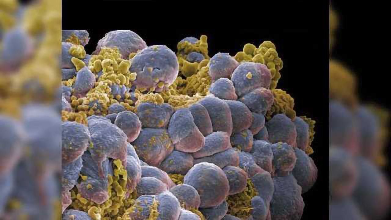 Making Resistant Melanomas Susceptible to Immunotherapy