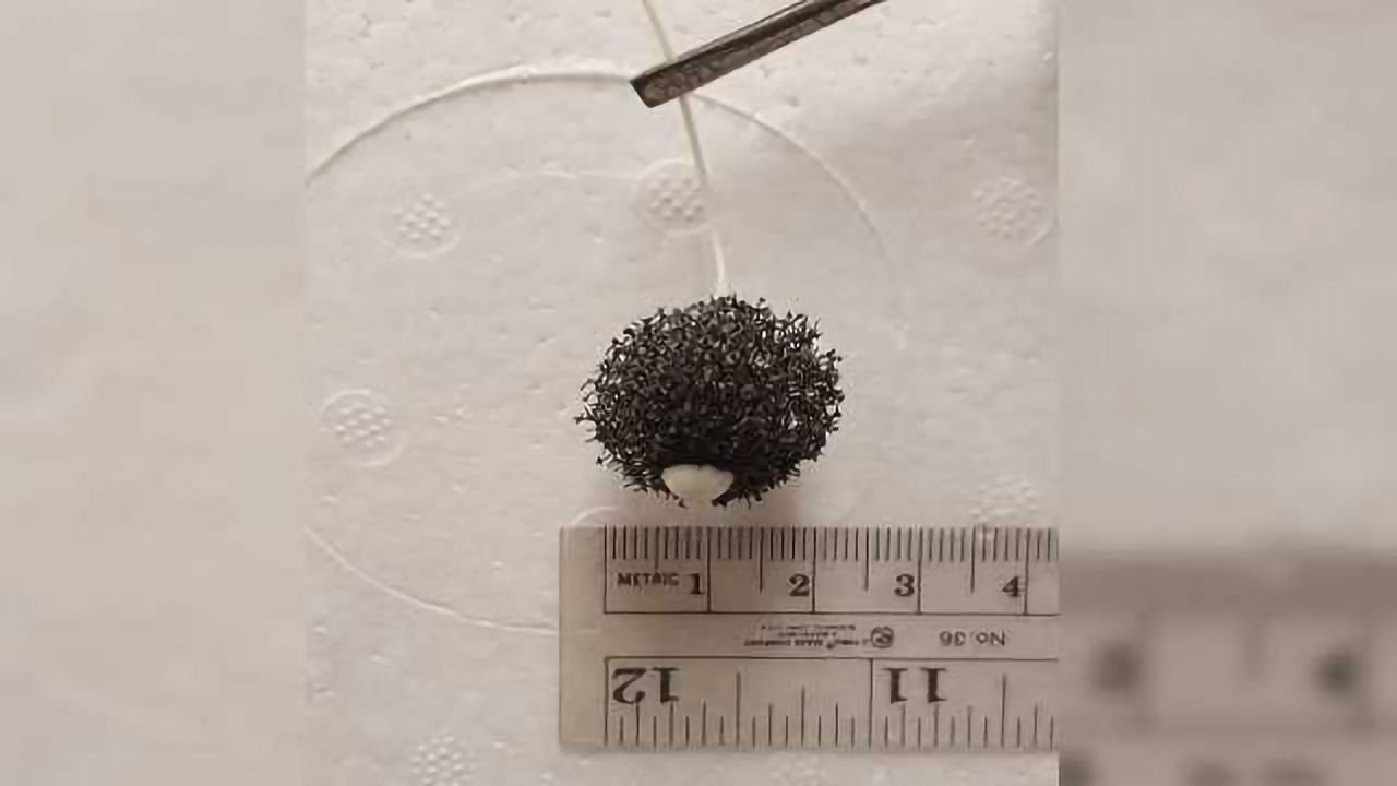 Swallowing this Special Sponge Enables Esophageal Cancer Detection
