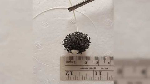 Swallowing this Special Sponge Enables Esophageal Cancer Detection