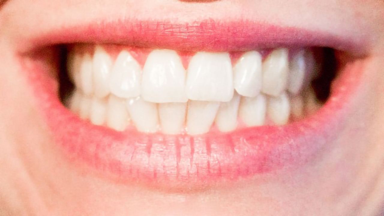 Study Implicates Gum Disease Bacteria in Alzheimer's Pathology