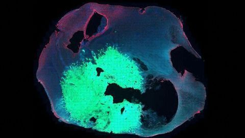 The Hitchhiker’s Guide to Defeating Glioblastoma