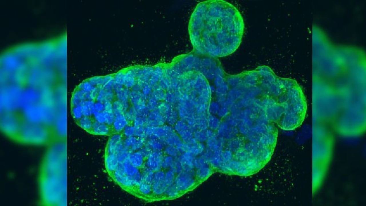 Researchers Reveal Signaling Pathway in Breast Cancer