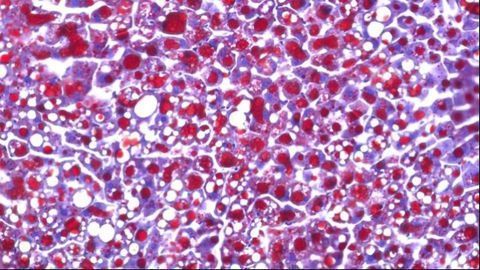 Causes of Cortisone-induced Side Effects Identified