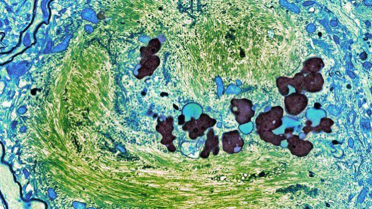 Anti-HIV Drug Targets Tau in Alzheimer's Neurons