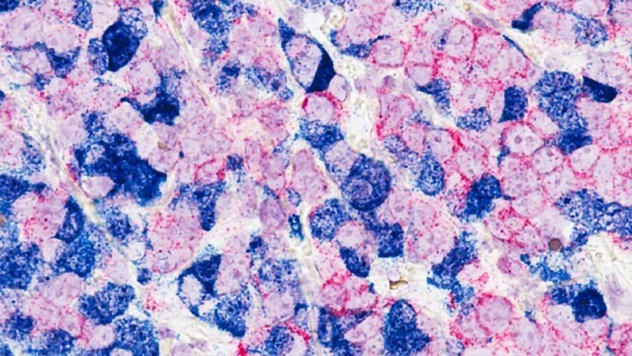 Mechanism Behind Breast Cancer Cell Plasticity Uncovered
