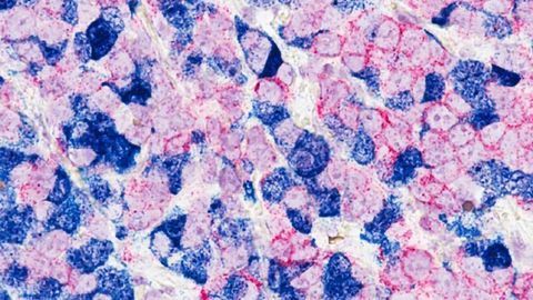 Mechanism Behind Breast Cancer Cell Plasticity Uncovered