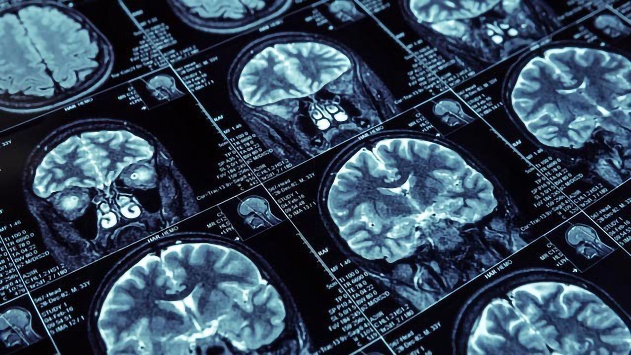 FGL2 Protein May Be an Effective Target for Glioblastoma
