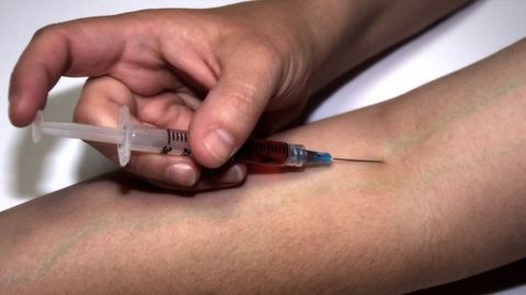Endocarditis Risk Increased for Injected Opioid Users
