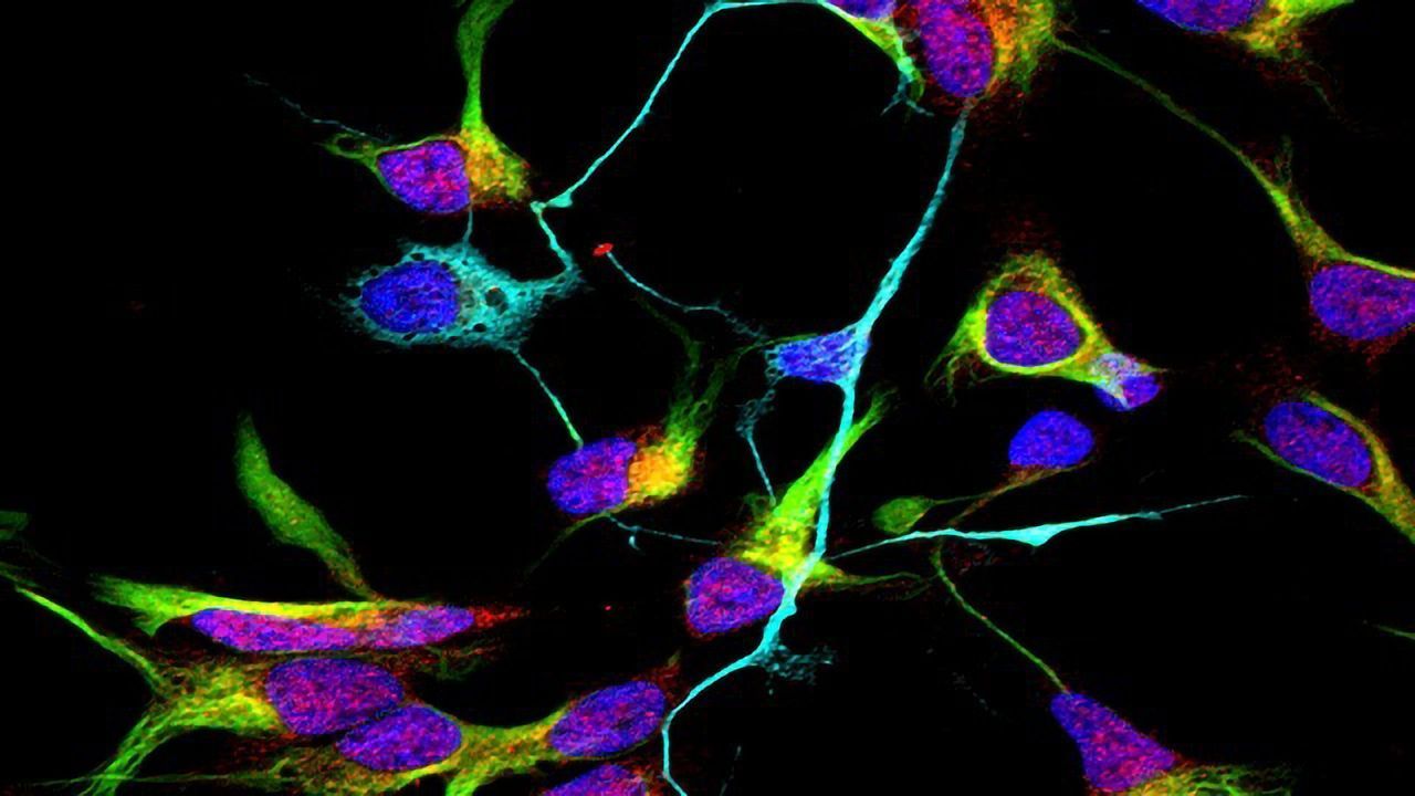 Sporadic Alzheimer’s in a Dish