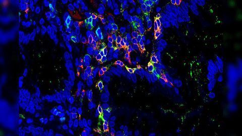 Tissue-resident Memory T Cells Involved in IBD Development