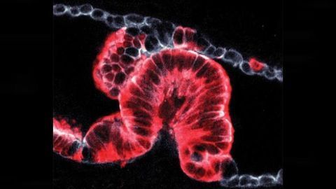 3D Imaging Reveals How Pancreatic Cancers Start
