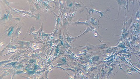 Aging Promotes Cancer Development, and Vice Versa