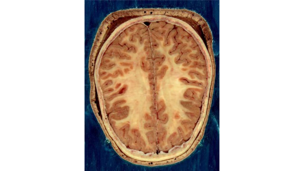 Ageing Damages the Brain's Support Cells