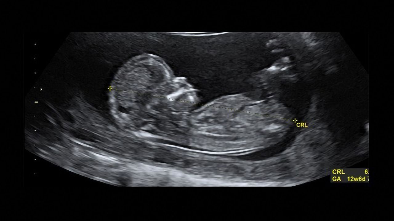 Genetic Testing Gives Answers on Developmental Disorders During Pregnancy