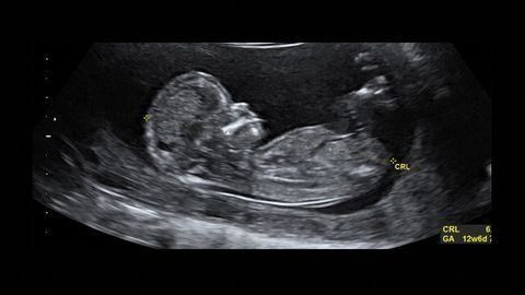 Genetic Testing Gives Answers on Developmental Disorders During Pregnancy