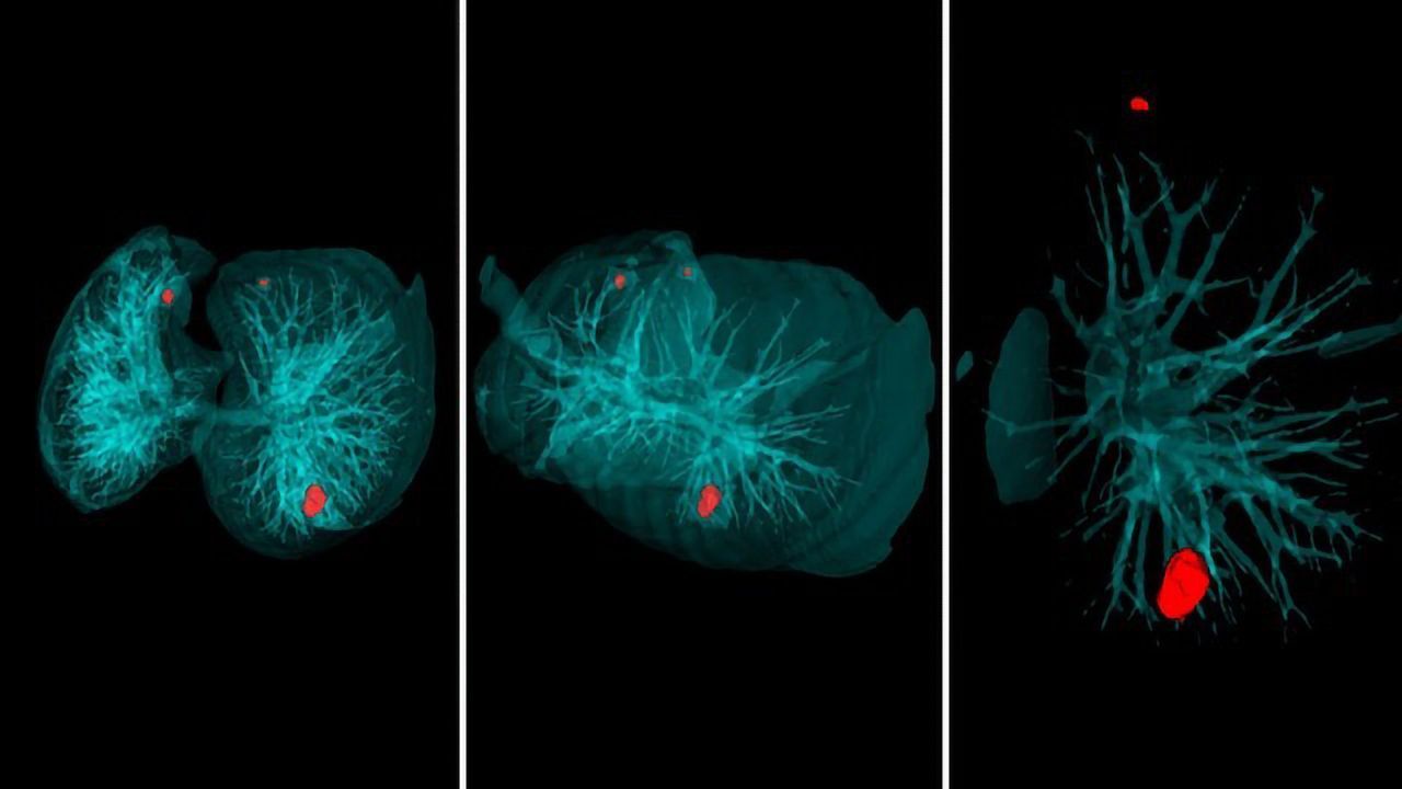 AI for Lung Cancer Diagnostics