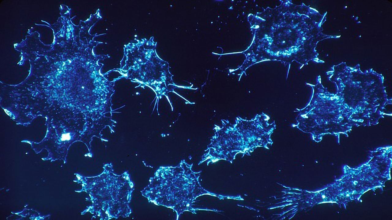 Novel Genetic Marker in Ovarian and Lung Cancers