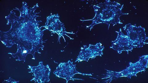Novel Genetic Marker in Ovarian and Lung Cancers